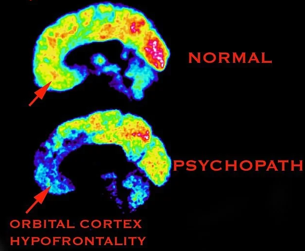 MRI
